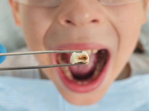 Best Broken Tooth Emergency  in Oakdale, MN